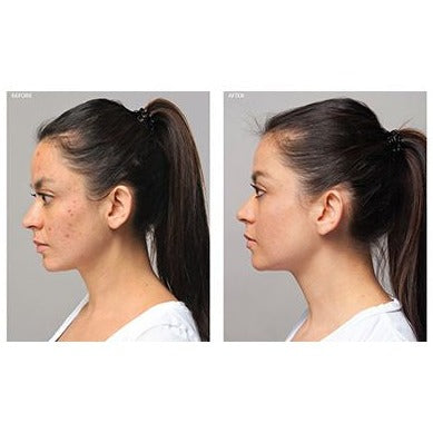 Acne Advanced Cleansing Foam